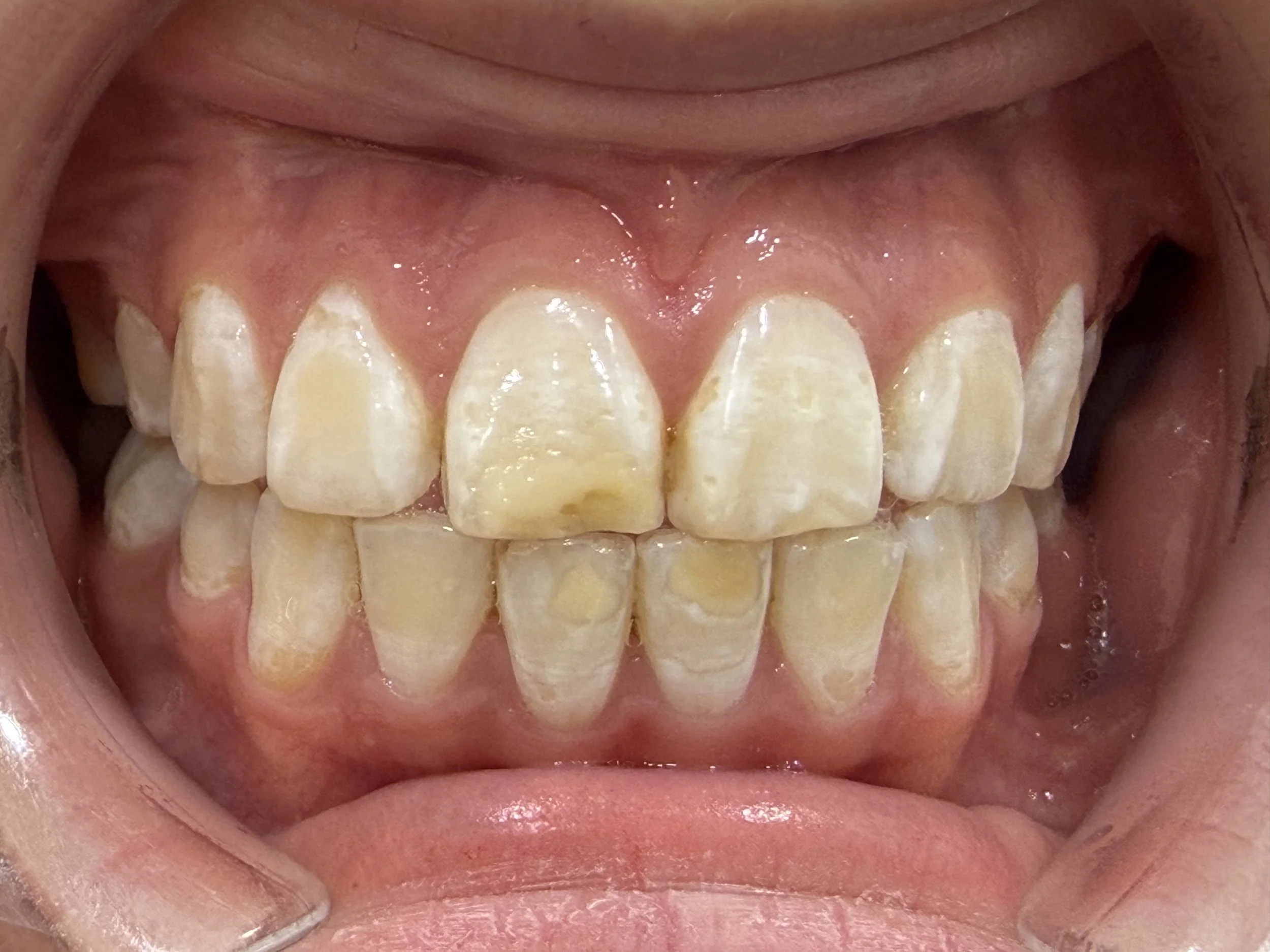 Dental Treatment Before 4
