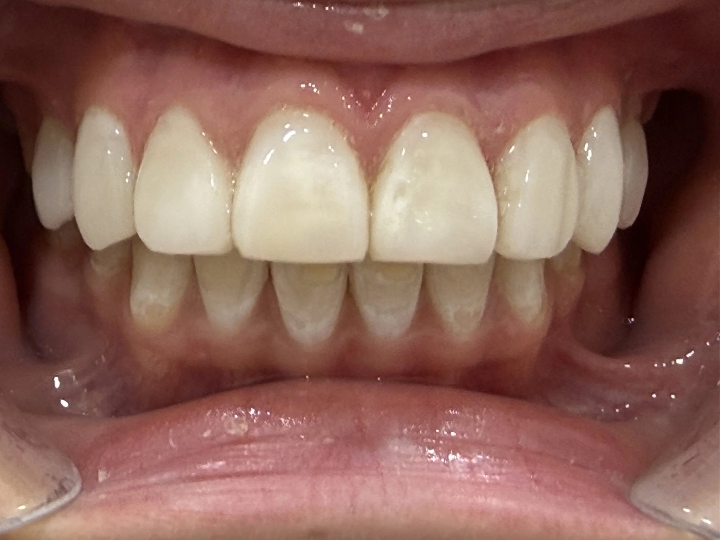 Dental Treatment After 4