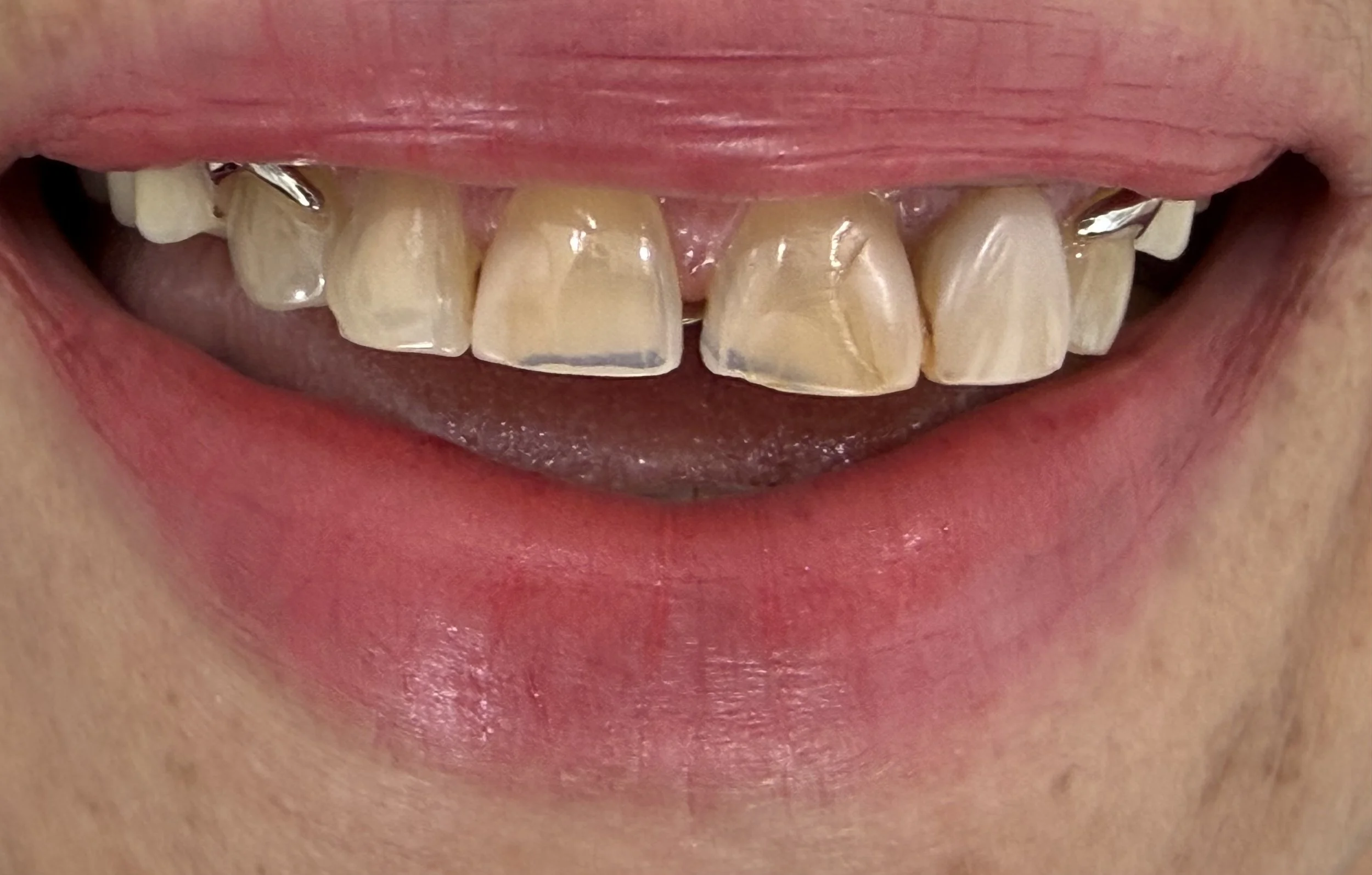 Dental Treatment Before 5